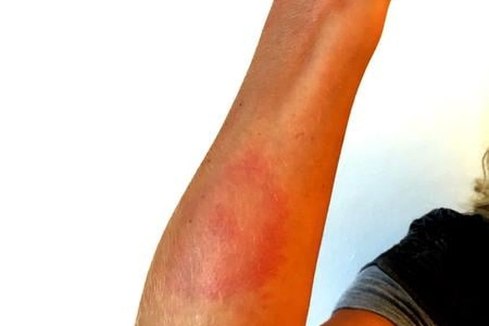 Een allergische reactie na een muggenbeet.